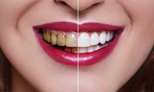 Blanqueamiento dental en TuOdontoFit - Dientes más blancos y brillantes