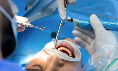 Carillas dentales en TuOdontoFit - Restauración de dientes perdidos