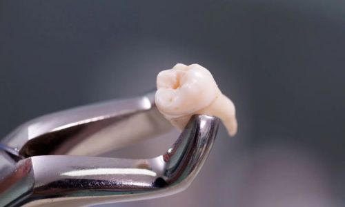 Cirugía  en TuOdontoFit - Una extracción dental es un procedimiento para sacar un diente de su lugar en el hueso y la encía